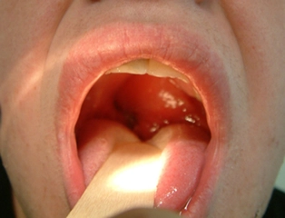 Gırtlak İltihabı Belirtileri ve Tedavisi Gırtlak İltihabı Belirtileri ve Tedavisi