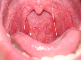 Gırtlak Tümörü Belirtileri ve Tedavisi